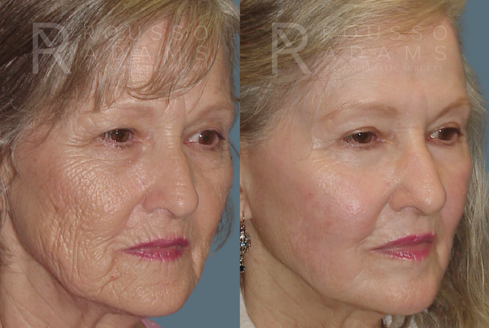 Deep Chemical Peel Gallery <span class=small>By Dr. Daniel Rousso</span> Before & After Gallery - Patient 271518 - Image 1