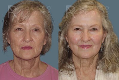 Deep Chemical Peel Gallery <span class=small>By Dr. Daniel Rousso</span> Before & After Gallery - Patient 271518 - Image 2