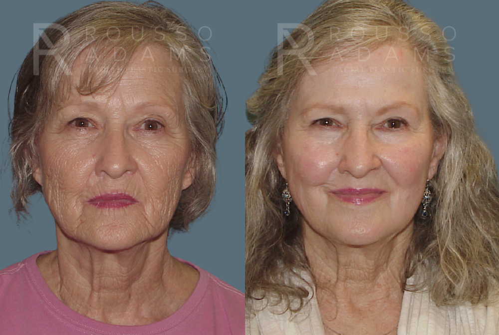 Deep Chemical Peel Gallery <span class=small>By Dr. Daniel Rousso</span> Before & After Gallery - Patient 271518 - Image 2
