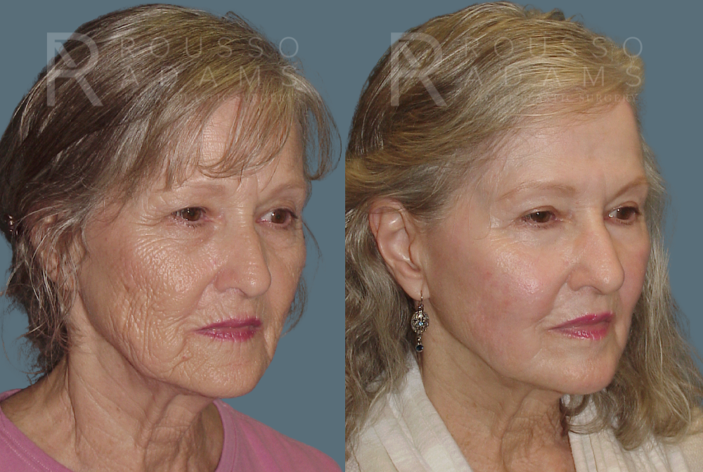 Deep Chemical Peel Gallery <span class=small>By Dr. Daniel Rousso</span> Before & After Gallery - Patient 271518 - Image 3