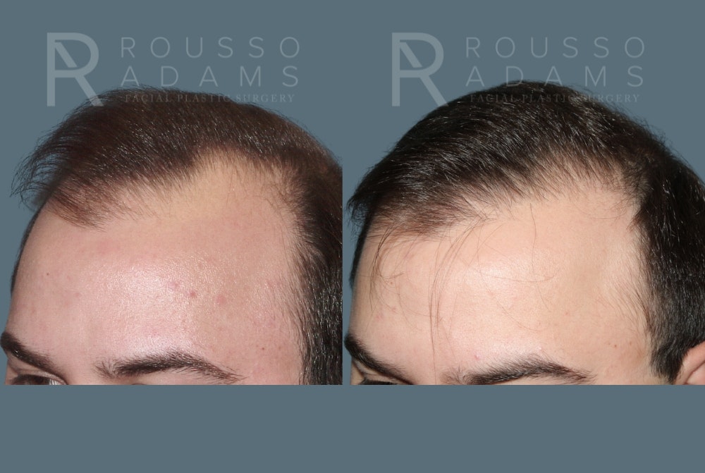 Hair Transplant Before & After Gallery - Patient 123311 - Image 1