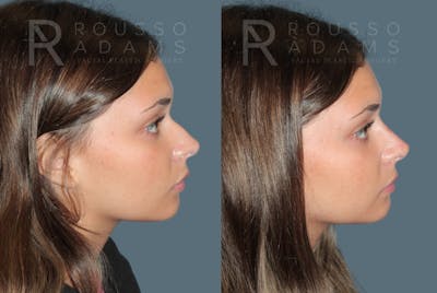 Liquid Rhinoplasty Gallery Before & After Gallery - Patient 149283982 - Image 1