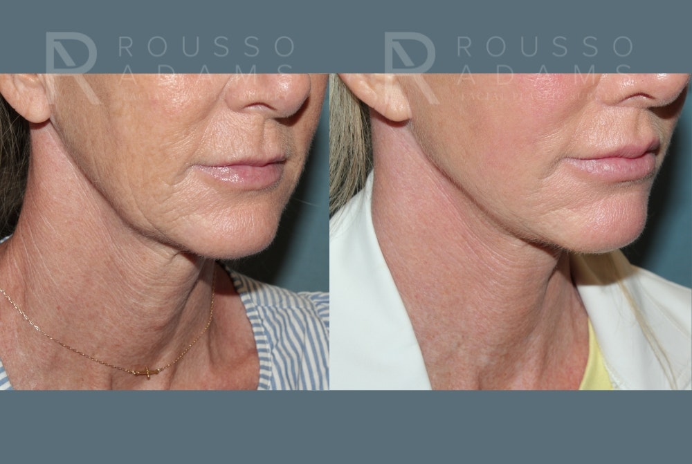 Lip Augmentation Gallery<span class=small>By Dr. Daniel Rousso</span> Before & After Gallery - Patient 309834 - Image 2