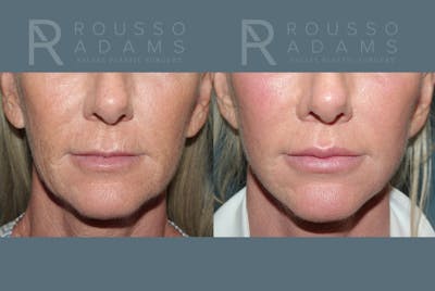 Lip Augmentation Gallery<span class=small>By Dr. Daniel Rousso</span> Before & After Gallery - Patient 309834 - Image 1