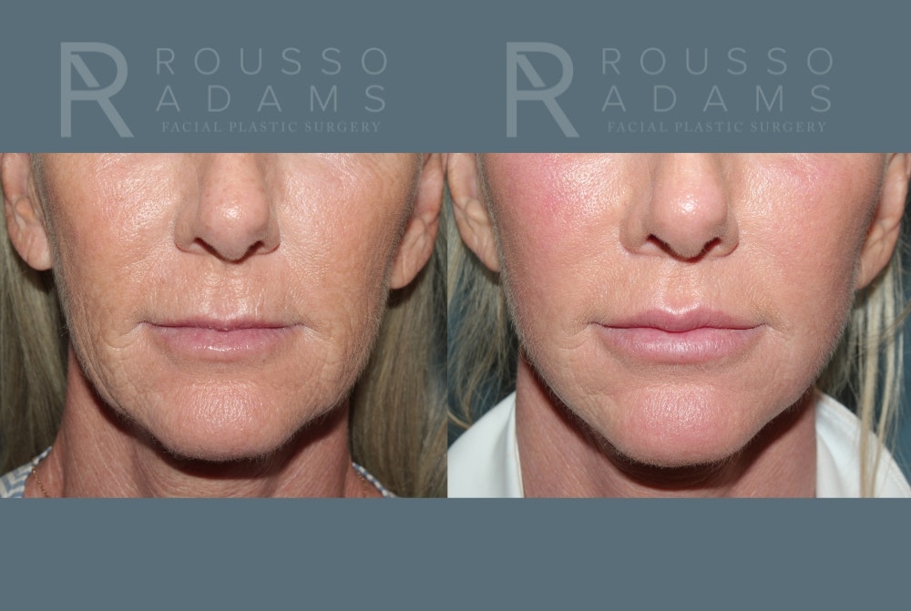 Lip Augmentation Gallery<span class=small>By Dr. Daniel Rousso</span> Before & After Gallery - Patient 309834 - Image 1