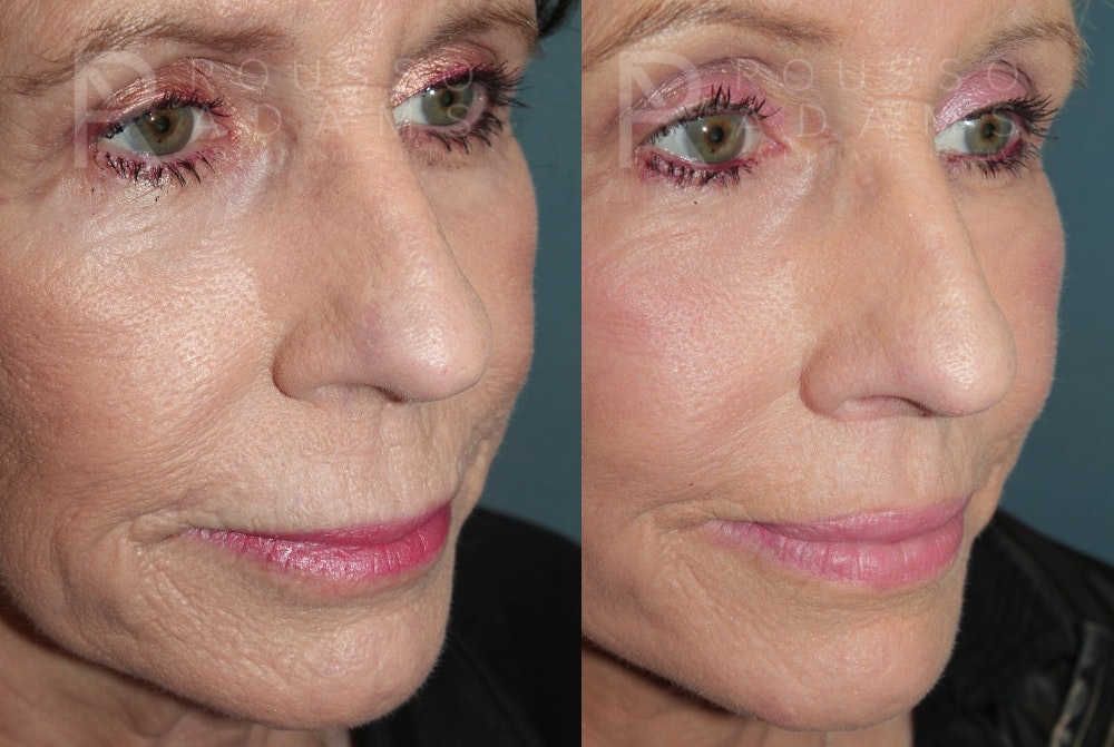 Lip Augmentation Gallery<span class=small>By Dr. Daniel Rousso</span> Before & After Gallery - Patient 336934 - Image 3