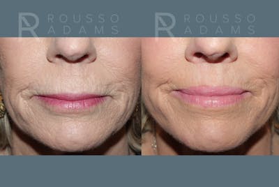 Lip Augmentation Gallery<span class=small>By Dr. Daniel Rousso</span> Before & After Gallery - Patient 336934 - Image 1