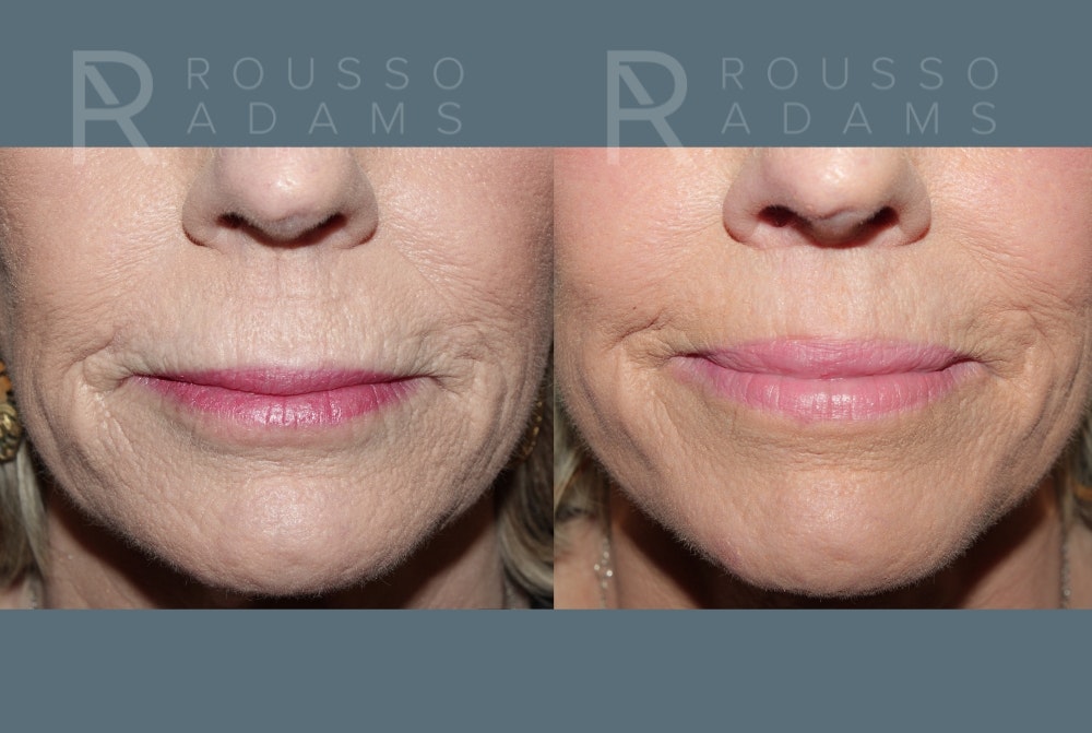 Lip Augmentation Gallery<span class=small>By Dr. Daniel Rousso</span> Before & After Gallery - Patient 336934 - Image 1