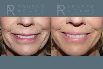 Lip Augmentation Gallery<span class=small>By Dr. Daniel Rousso</span> Before & After Gallery - Patient 336934 - Image 2