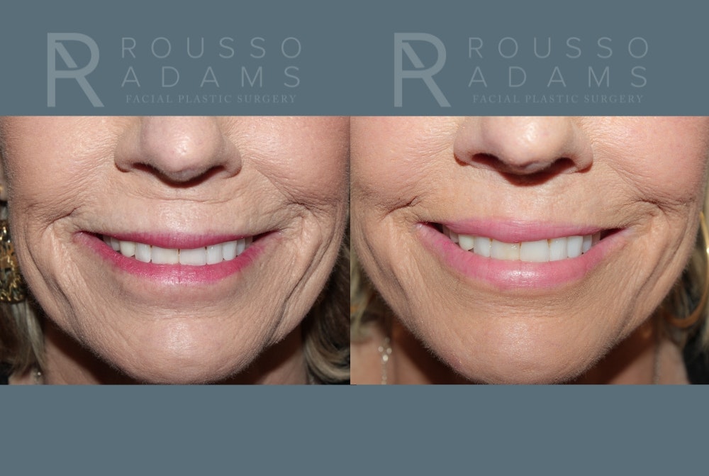 Lip Augmentation Gallery<span class=small>By Dr. Daniel Rousso</span> Before & After Gallery - Patient 336934 - Image 2