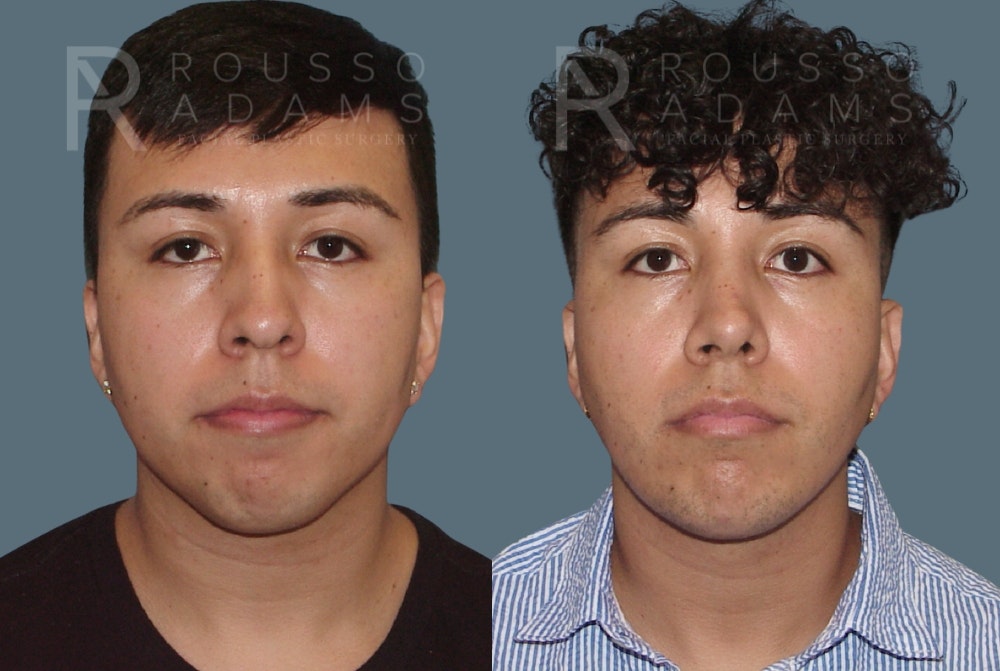 Facial Implants <span class=small>By Dr. Daniel Rousso</span> Before & After Gallery - Patient 101656 - Image 3