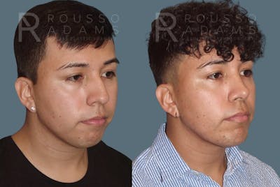Facial Implants <span class=small>By Dr. Daniel Rousso</span> Before & After Gallery - Patient 101656 - Image 2