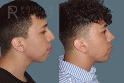 Facial Implants <span class=small>By Dr. Daniel Rousso</span> Before & After Gallery - Patient 101656 - Image 1