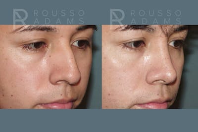 Facial Implants <span class=small>By Dr. Daniel Rousso</span> Before & After Gallery - Patient 101656 - Image 4