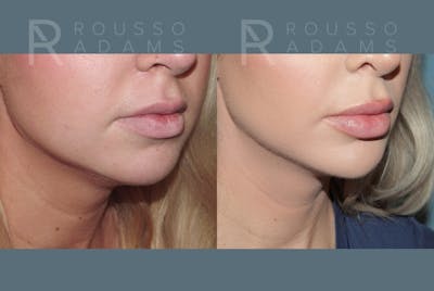Rhinoplasty <span class=small>By Dr. Daniel Rousso</span> Before & After Gallery - Patient 409961 - Image 6
