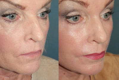 Deep Plane Facelift <span class=small>By Dr. Daniel Rousso</span> Before & After Gallery - Patient 190879 - Image 4
