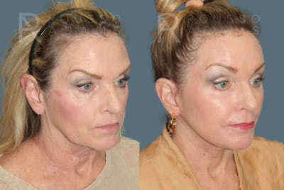 Deep Plane Facelift <span class=small>By Dr. Daniel Rousso</span> Before & After Gallery - Patient 190879 - Image 1