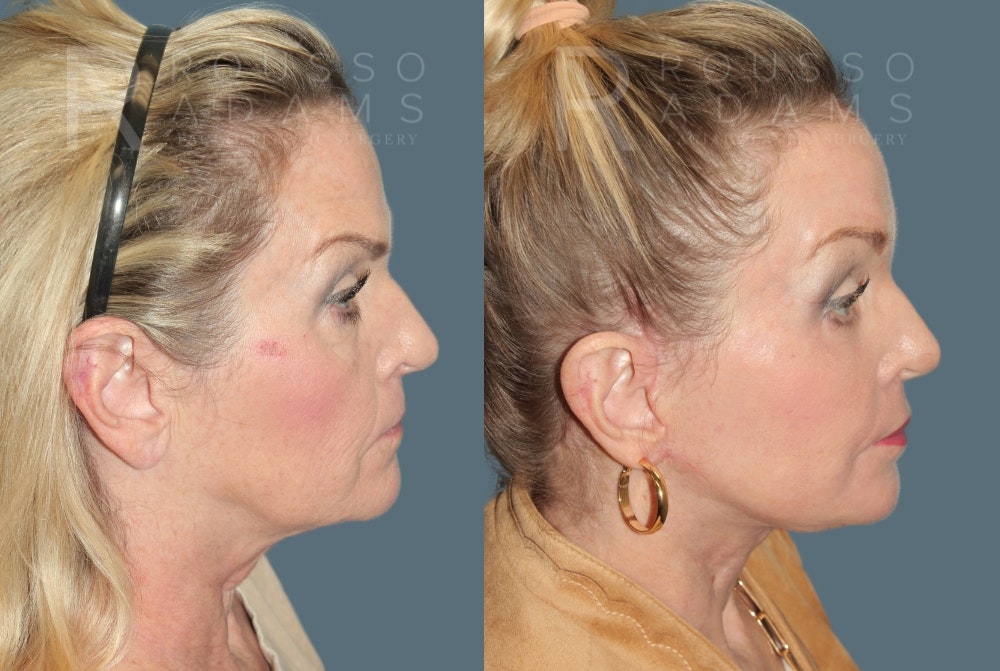 Deep Plane Facelift <span class=small>By Dr. Daniel Rousso</span> Before & After Gallery - Patient 190879 - Image 2