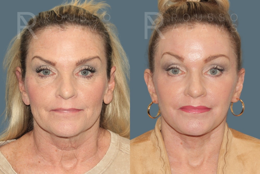 Deep Plane Facelift <span class=small>By Dr. Daniel Rousso</span> Before & After Gallery - Patient 190879 - Image 3