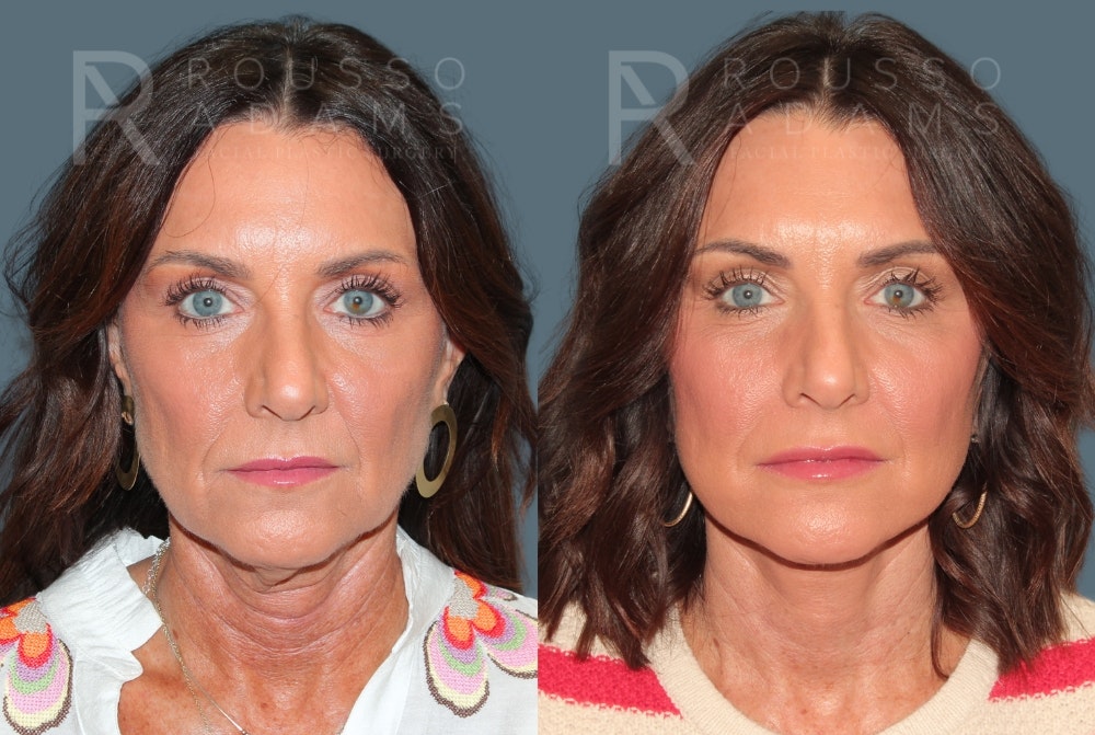 Deep Plane Facelift <span class=small>By Dr. Daniel Rousso</span> Before & After Gallery - Patient 348567 - Image 3