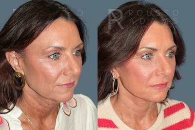 Deep Plane Facelift <span class=small>By Dr. Daniel Rousso</span> Before & After Gallery - Patient 348567 - Image 1