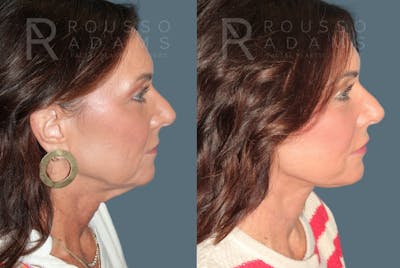 Deep Plane Facelift <span class=small>By Dr. Daniel Rousso</span> Before & After Gallery - Patient 348567 - Image 2