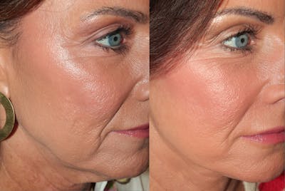 Deep Plane Facelift <span class=small>By Dr. Daniel Rousso</span> Before & After Gallery - Patient 348567 - Image 4