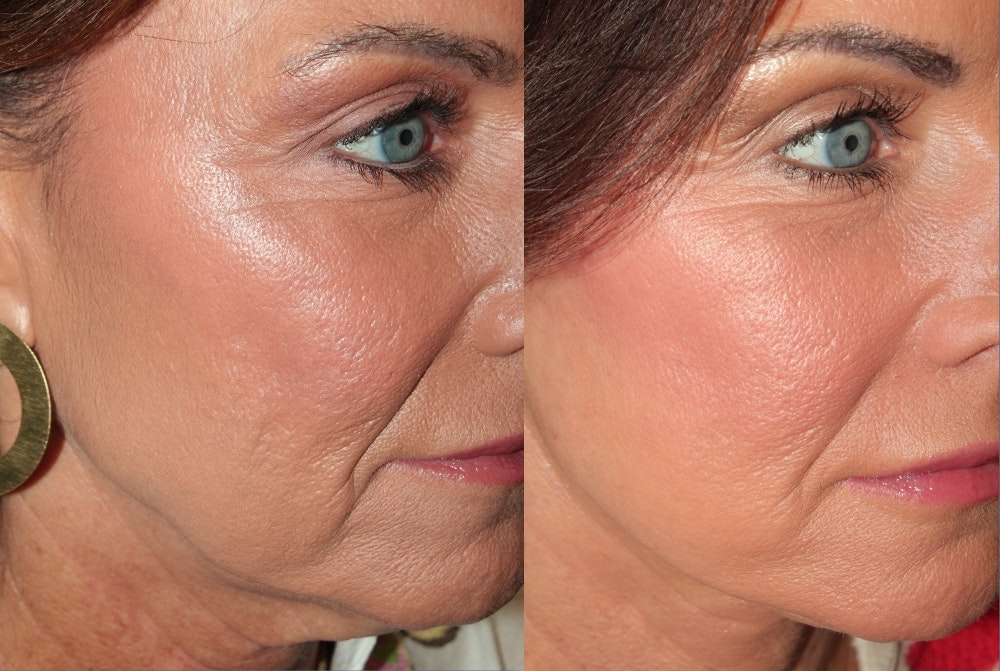 Deep Plane Facelift <span class=small>By Dr. Daniel Rousso</span> Before & After Gallery - Patient 348567 - Image 4