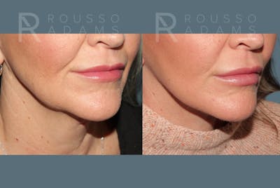 Deep Plane Facelift <span class=small>By Dr. Daniel Rousso</span> Before & After Gallery - Patient 363671 - Image 4
