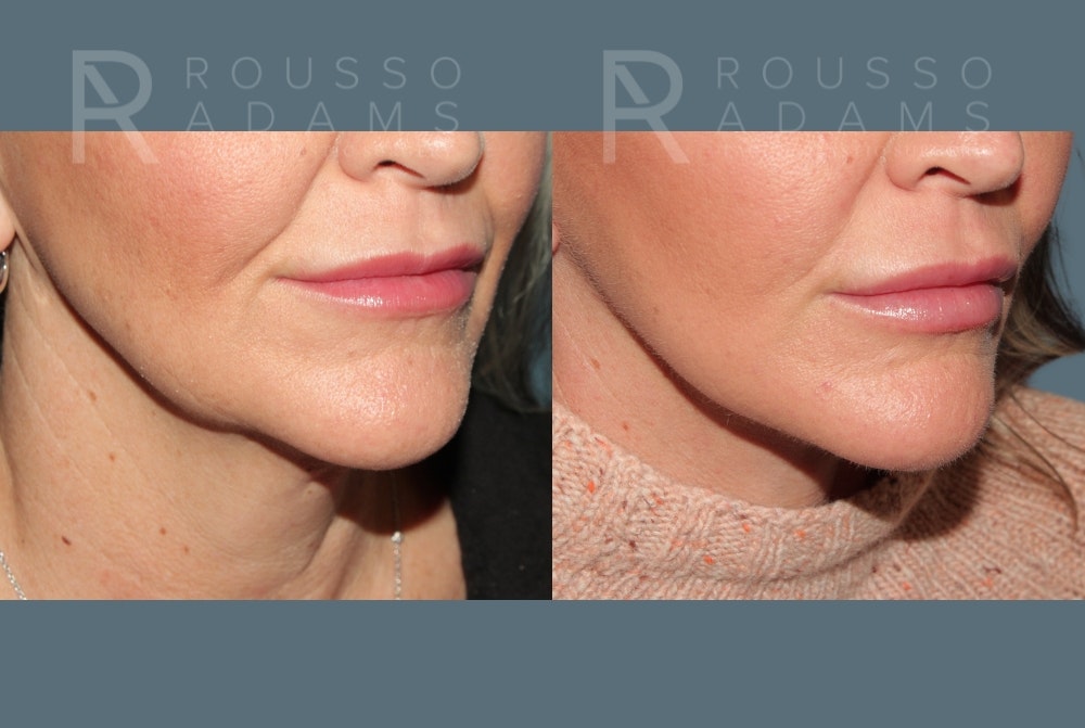 Deep Plane Facelift <span class=small>By Dr. Daniel Rousso</span> Before & After Gallery - Patient 363671 - Image 4