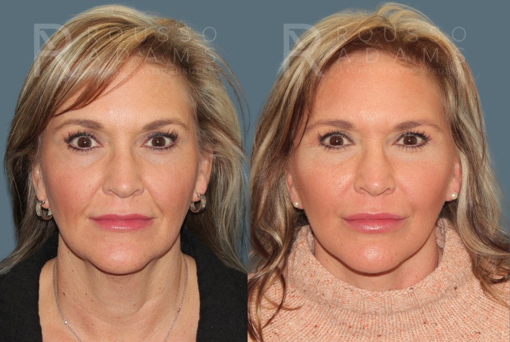 Deep Plane Facelift <span class=small>By Dr. Daniel Rousso</span> Before & After Gallery - Patient 363671 - Image 3