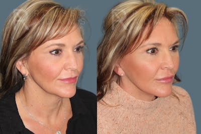Deep Plane Facelift <span class=small>By Dr. Daniel Rousso</span> Before & After Gallery - Patient 363671 - Image 1