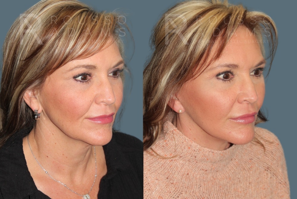Deep Plane Facelift <span class=small>By Dr. Daniel Rousso</span> Before & After Gallery - Patient 363671 - Image 1