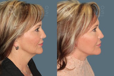 Deep Plane Facelift <span class=small>By Dr. Daniel Rousso</span> Before & After Gallery - Patient 363671 - Image 2
