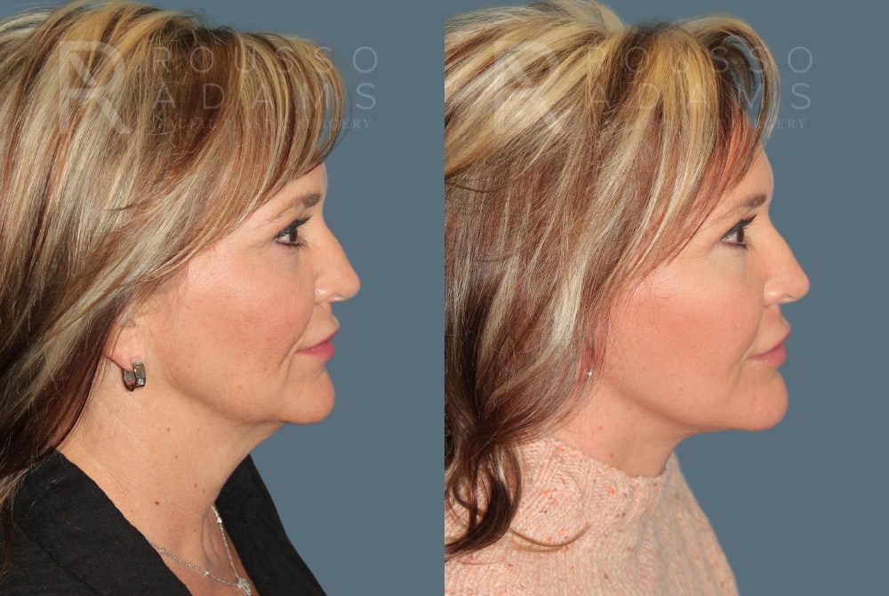 Deep Plane Facelift <span class=small>By Dr. Daniel Rousso</span> Before & After Gallery - Patient 363671 - Image 2