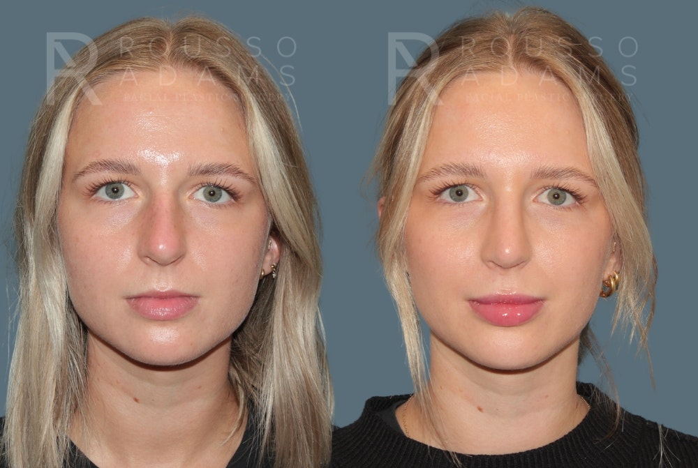 Rhinoplasty<span class=small>By Dr. Austin Adams</span> Before & After Gallery - Patient 252438 - Image 2