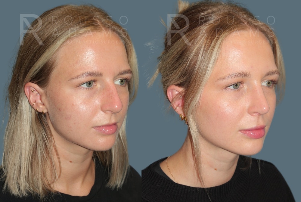 Rhinoplasty<span class=small>By Dr. Austin Adams</span> Before & After Gallery - Patient 252438 - Image 3