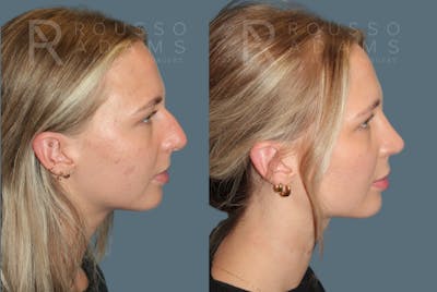 Rhinoplasty<span class=small>By Dr. Austin Adams</span> Before & After Gallery - Patient 252438 - Image 1