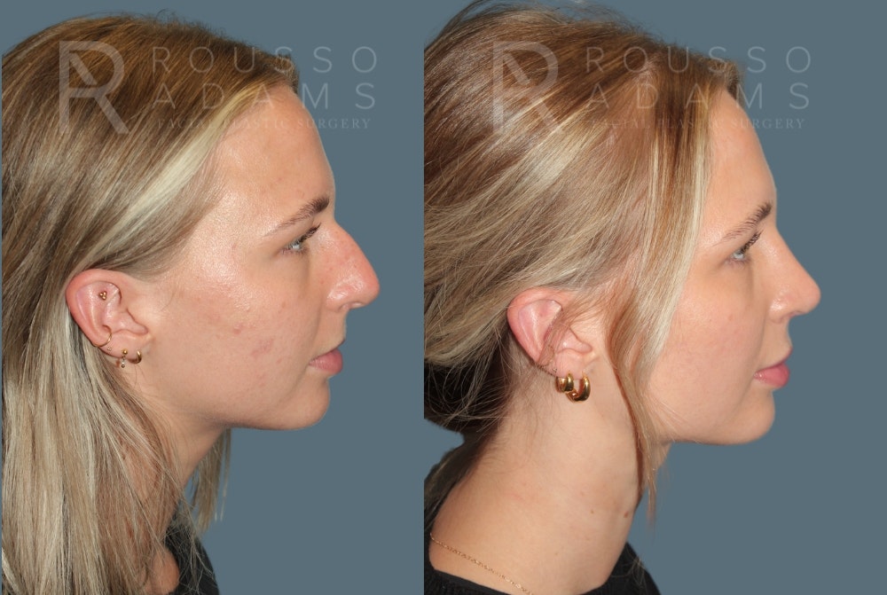 Rhinoplasty<span class=small>By Dr. Austin Adams</span> Before & After Gallery - Patient 252438 - Image 1