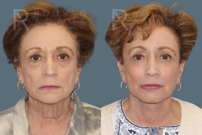 SculptLift™ <span class=small>By Dr. Daniel Rousso</span> Before & After Gallery - Patient 387577 - Image 1