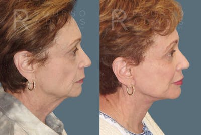 Facelift <span class=small>By Dr. Daniel Rousso</span> Before & After Gallery - Patient 103063 - Image 2