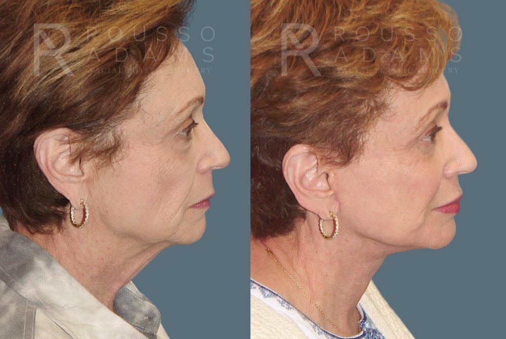 Facelift <span class=small>By Dr. Daniel Rousso</span> Before & After Gallery - Patient 103063 - Image 2