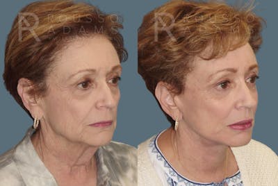 Facelift <span class=small>By Dr. Daniel Rousso</span> Before & After Gallery - Patient 103063 - Image 1
