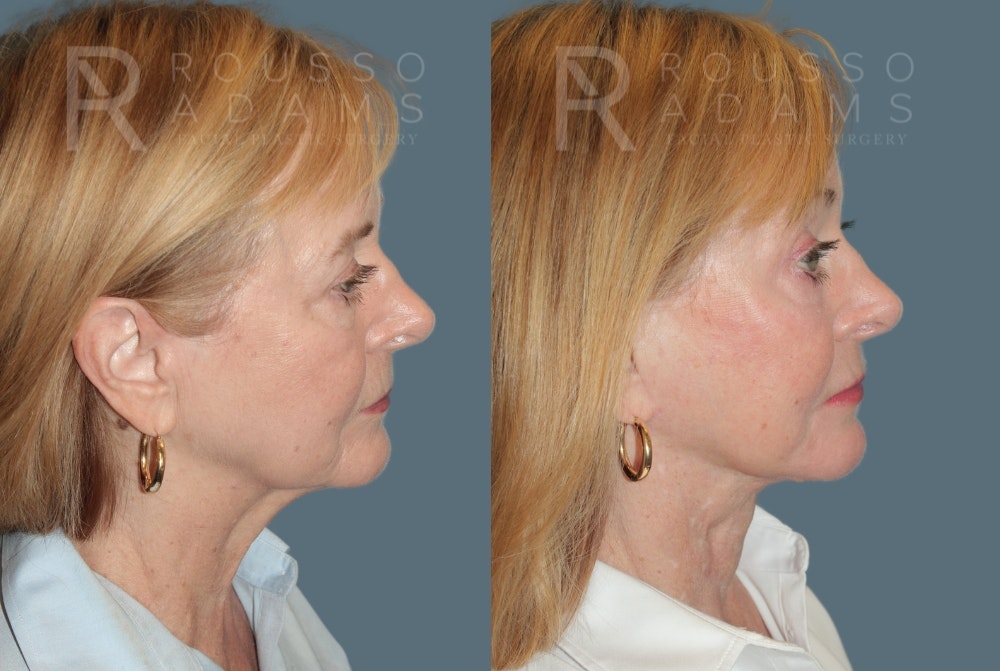 Facelift <span class=small>By Dr. Daniel Rousso</span> Before & After Gallery - Patient 454439 - Image 2