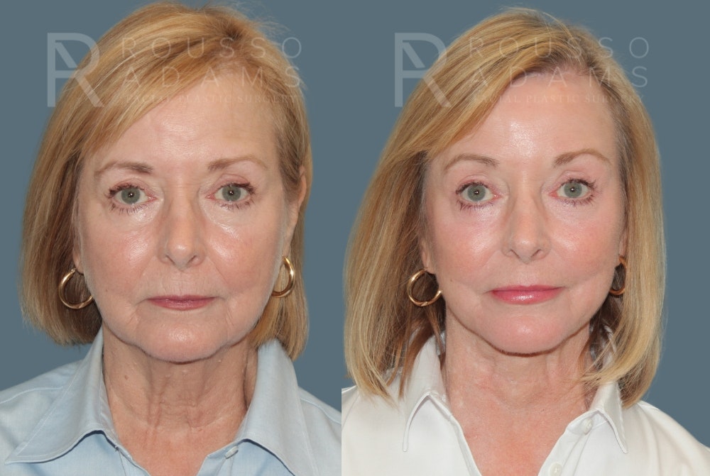 Facelift <span class=small>By Dr. Daniel Rousso</span> Before & After Gallery - Patient 454439 - Image 3