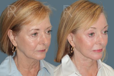 Facelift <span class=small>By Dr. Daniel Rousso</span> Before & After Gallery - Patient 454439 - Image 1