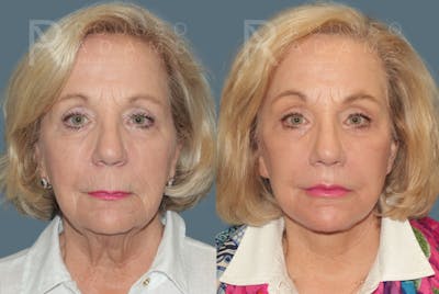 Deep Plane Facelift <span class=small>By Dr. Austin Adams</span> Before & After Gallery - Patient 190856 - Image 1