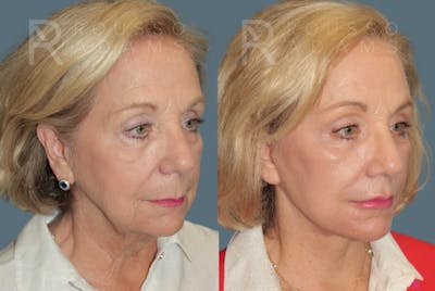Deep Plane Facelift <span class=small>By Dr. Austin Adams</span> Before & After Gallery - Patient 190856 - Image 2