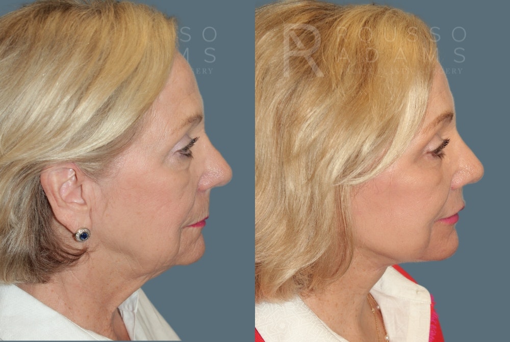 Deep Plane Facelift <span class=small>By Dr. Austin Adams</span> Before & After Gallery - Patient 190856 - Image 3