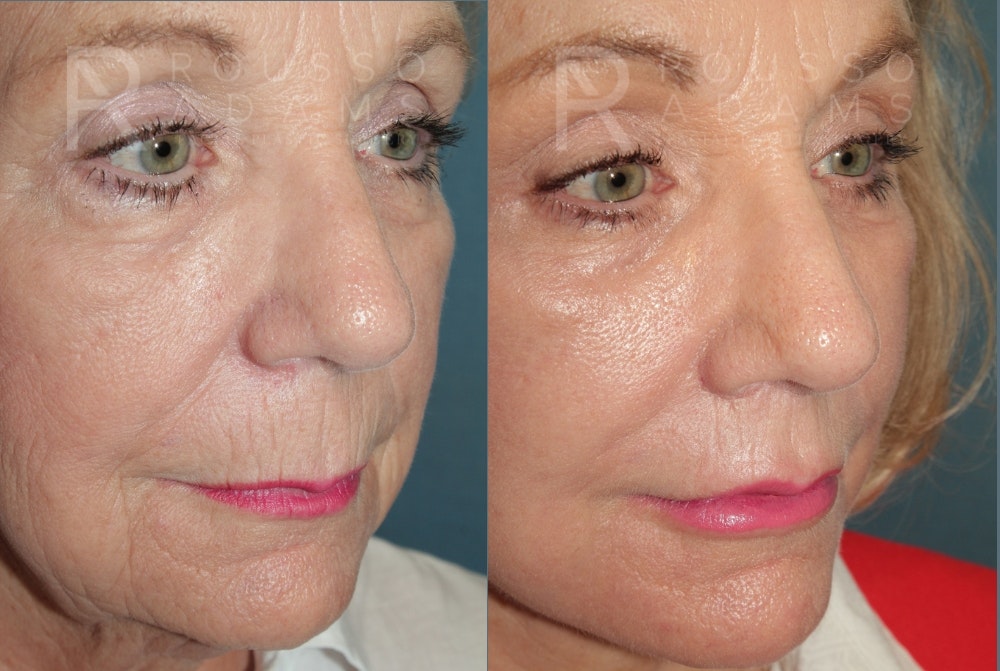 Deep Plane Facelift <span class=small>By Dr. Austin Adams</span> Before & After Gallery - Patient 190856 - Image 4